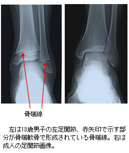 プラステンアップ は効果的 背を伸ばすなら 骨端線 が閉じていないうちに プラステンアップの口コミや評判を解説